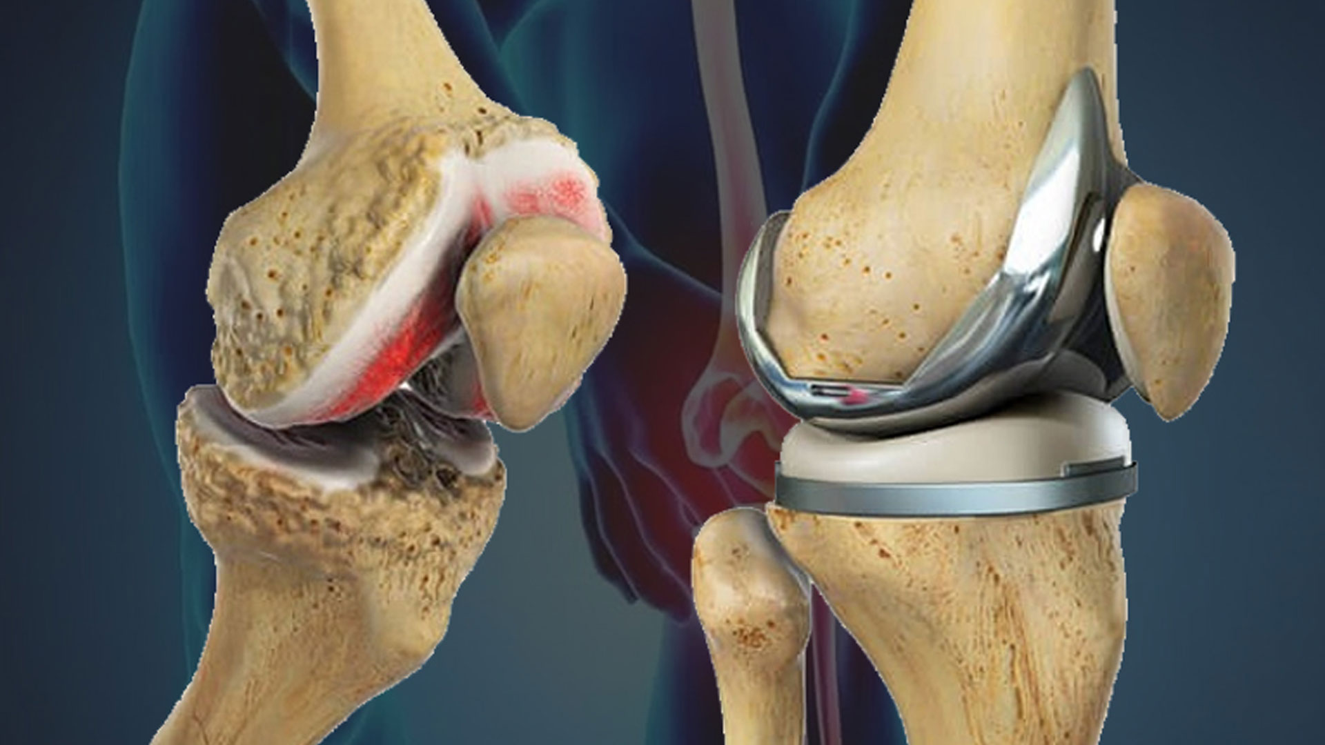 Joint Replacement Surgery by Dr. Sourabh Jatkar