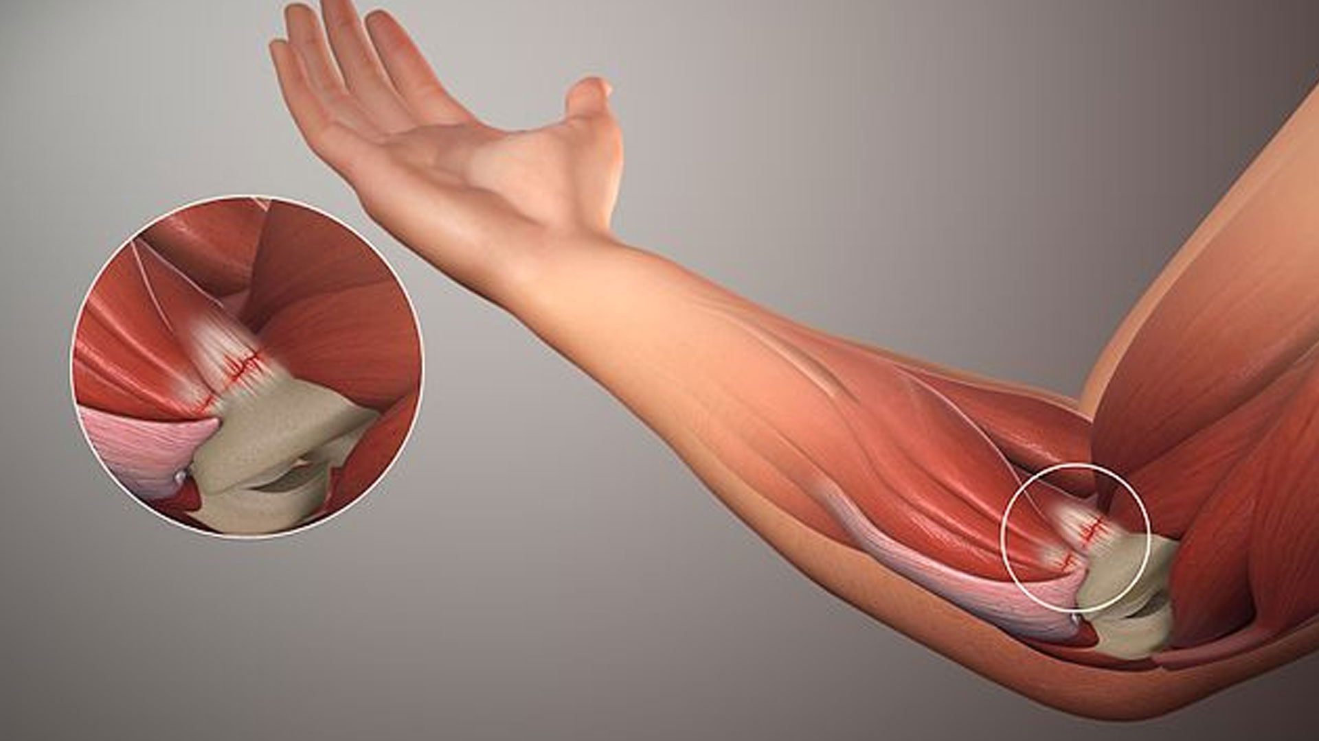 Tendonitis Treatment by Dr. Sourabh Jatkar